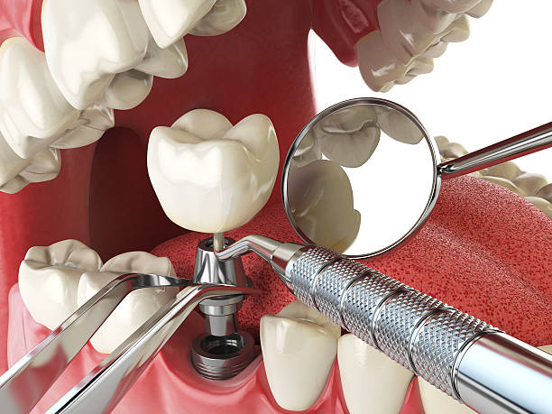 Best Emergency Denture Repair in Brunswick, OH
